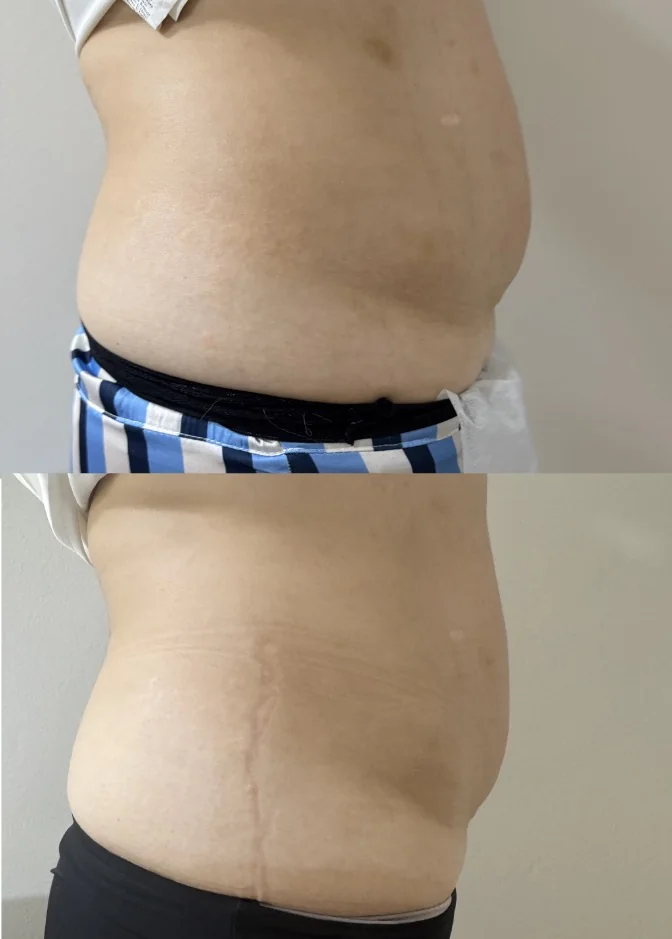 Perfil del abdomen antes y después del tratamiento corporal