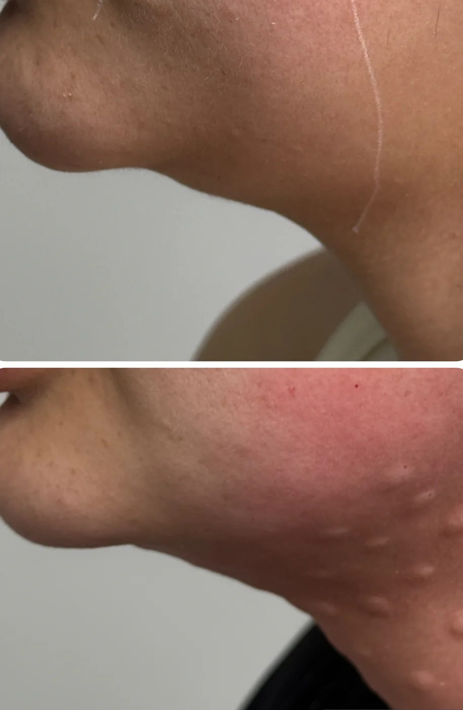 Zona de mandíbula y cuello antes y después del tratamiento