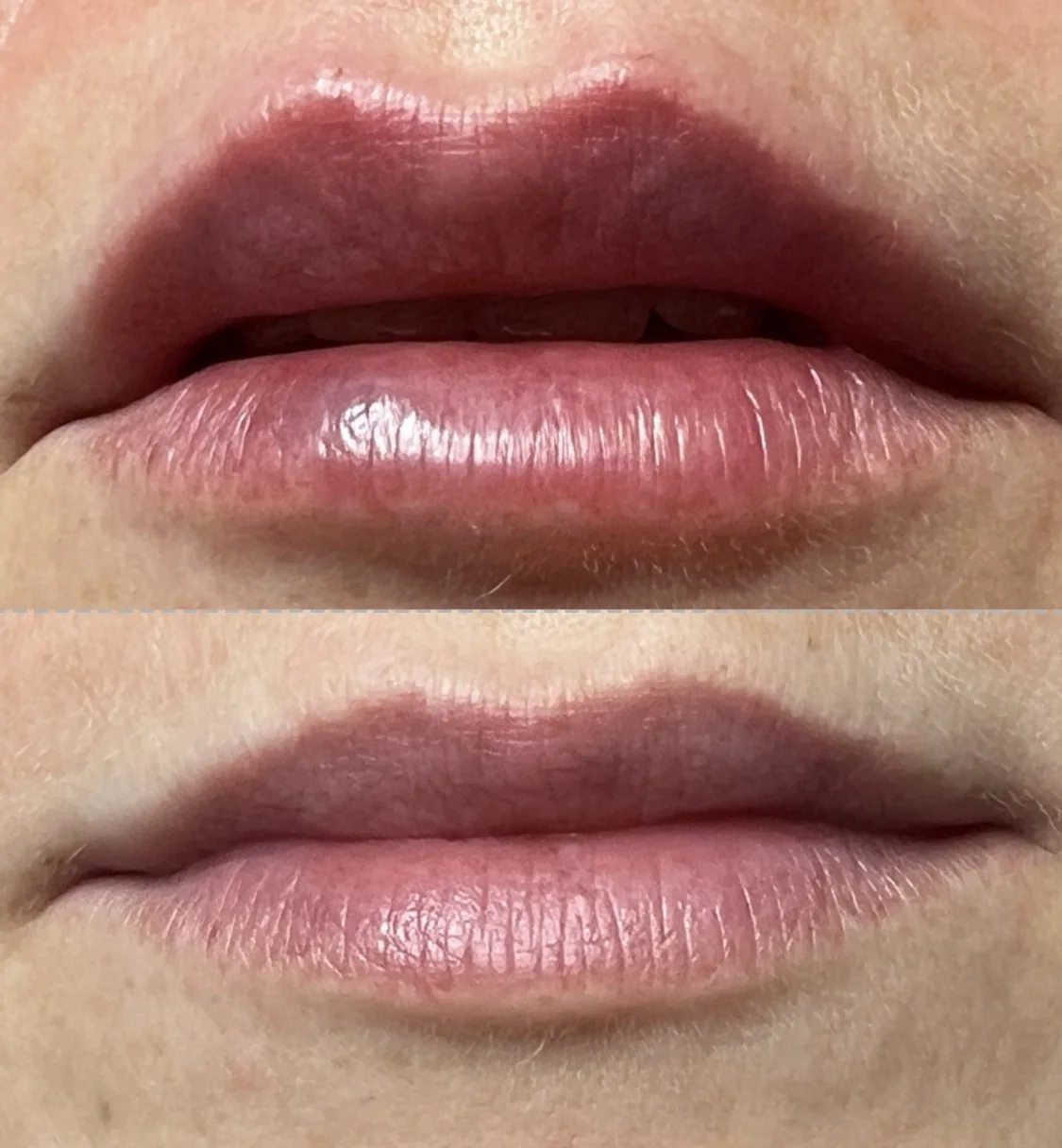 Labios antes y después del aumento de volumen