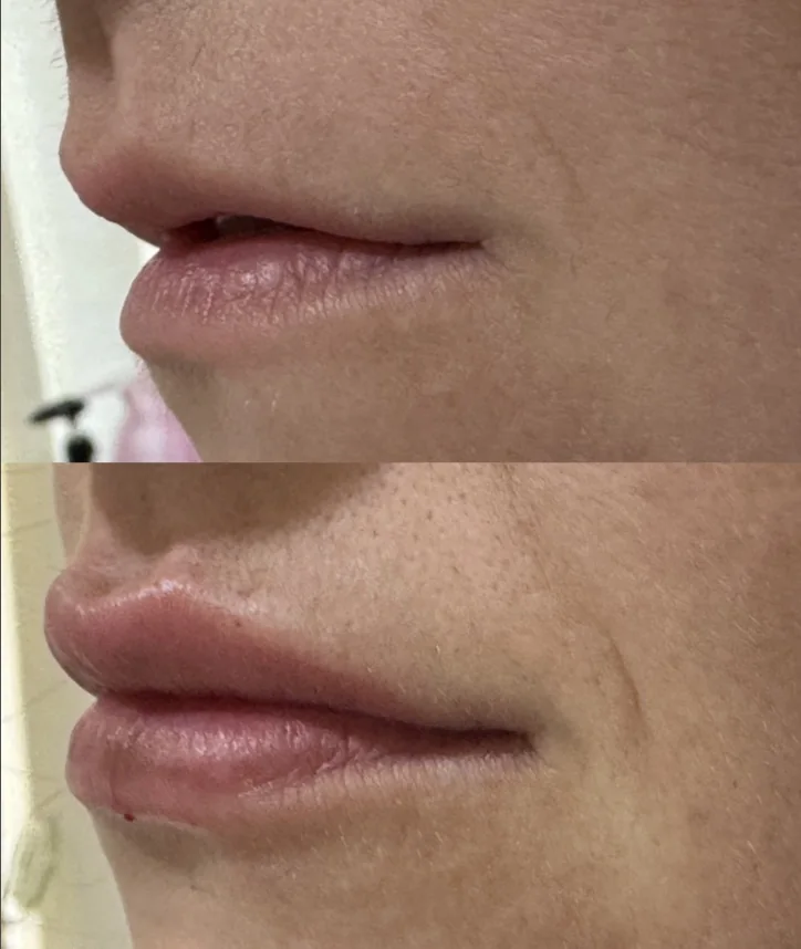 Labios de perfil antes y después del tratamiento