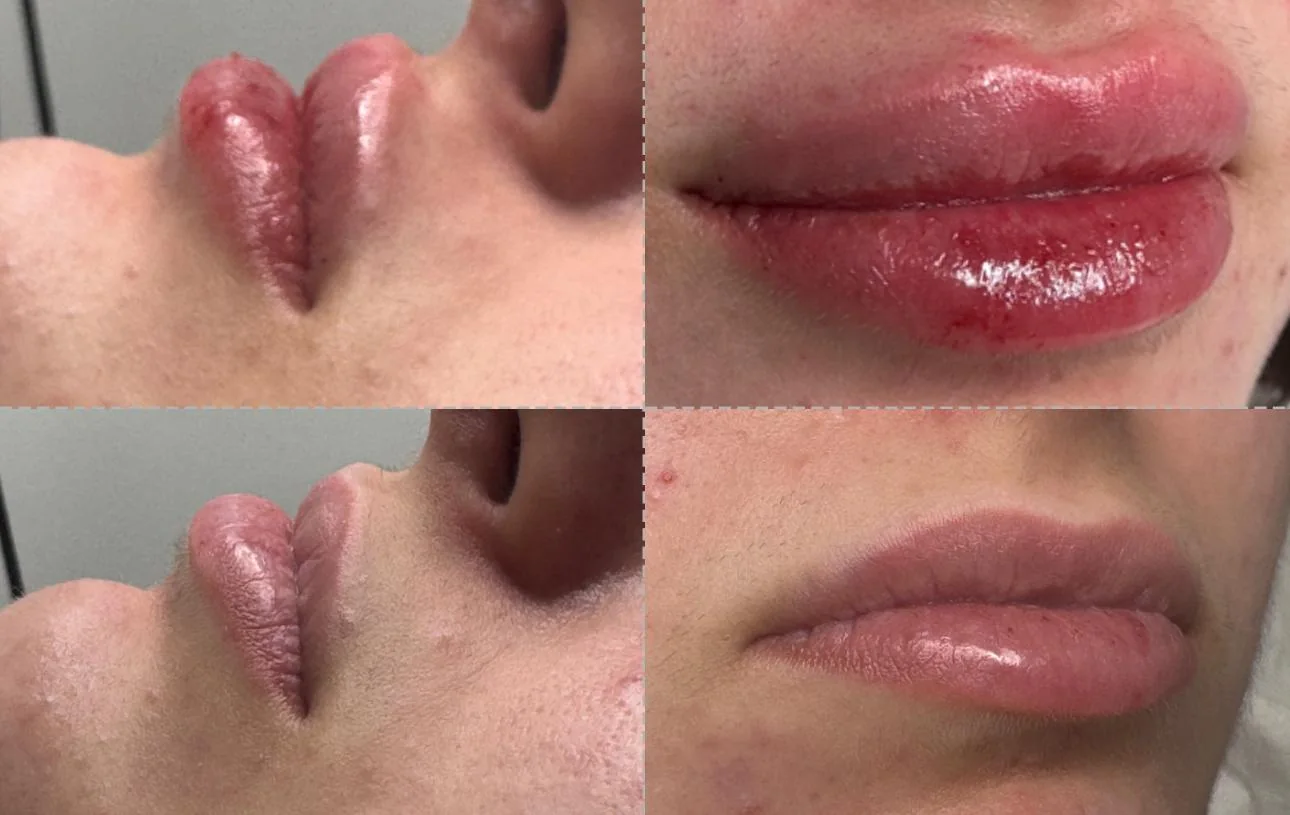 Labios fotografiados desde cuatro ángulos, antes y después del tratamiento
