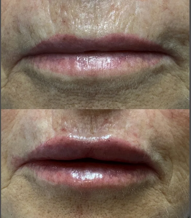 Labios antes y después del tratamiento de volumen