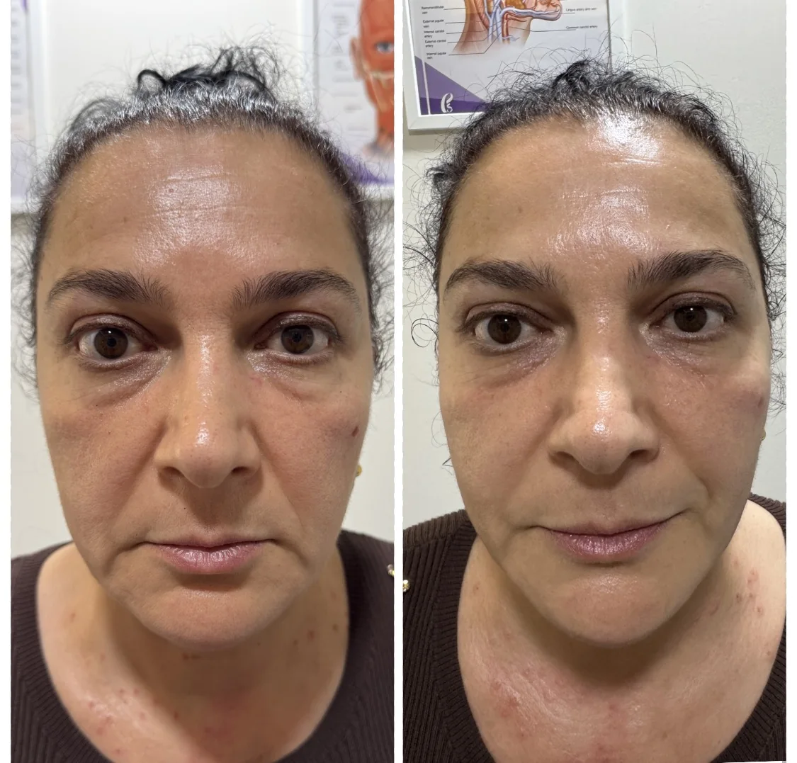 Rostro antes y después, fotografiado con el mismo encuadre