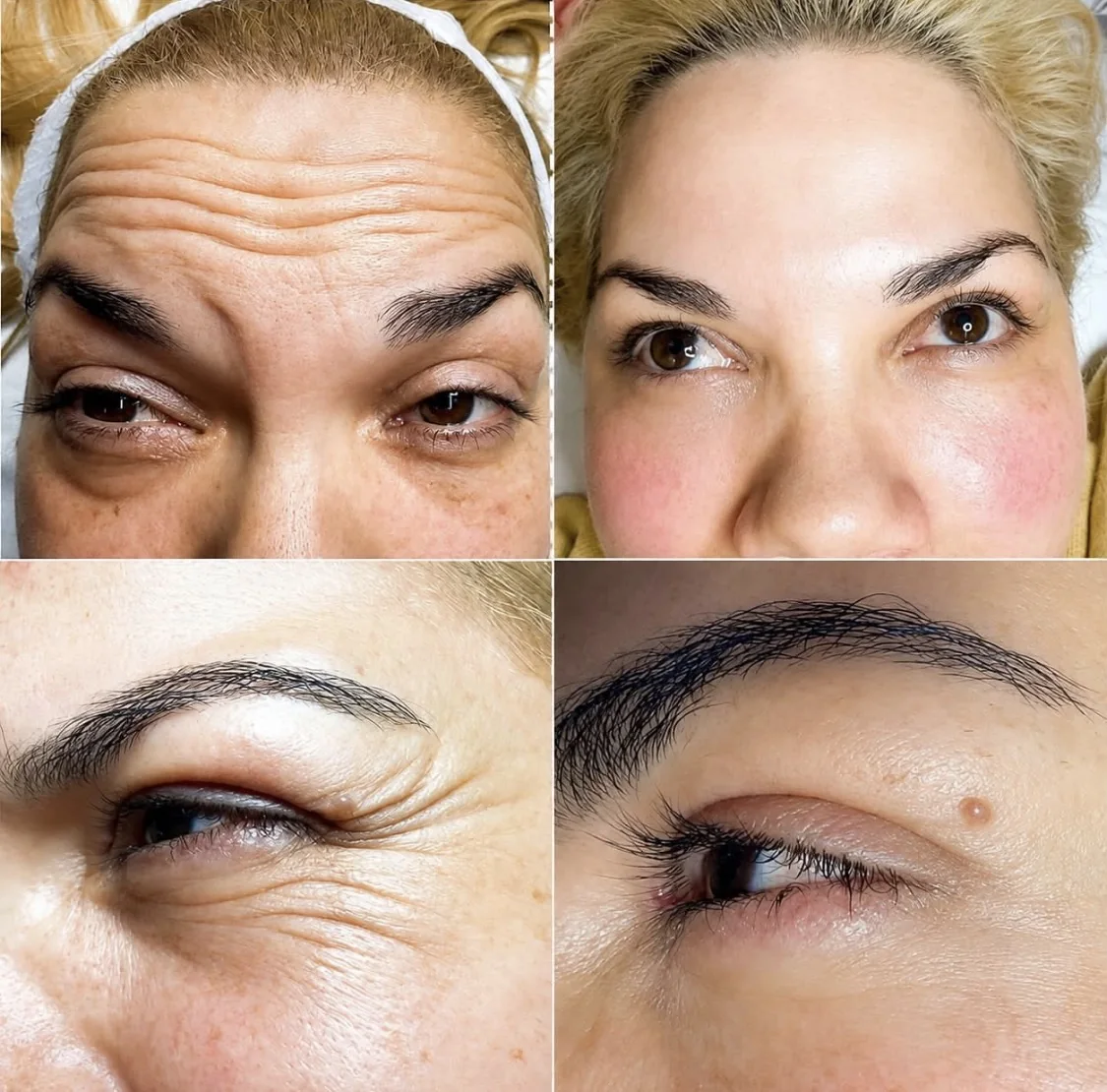 Contorno de ojos y cejas antes y después del tratamiento