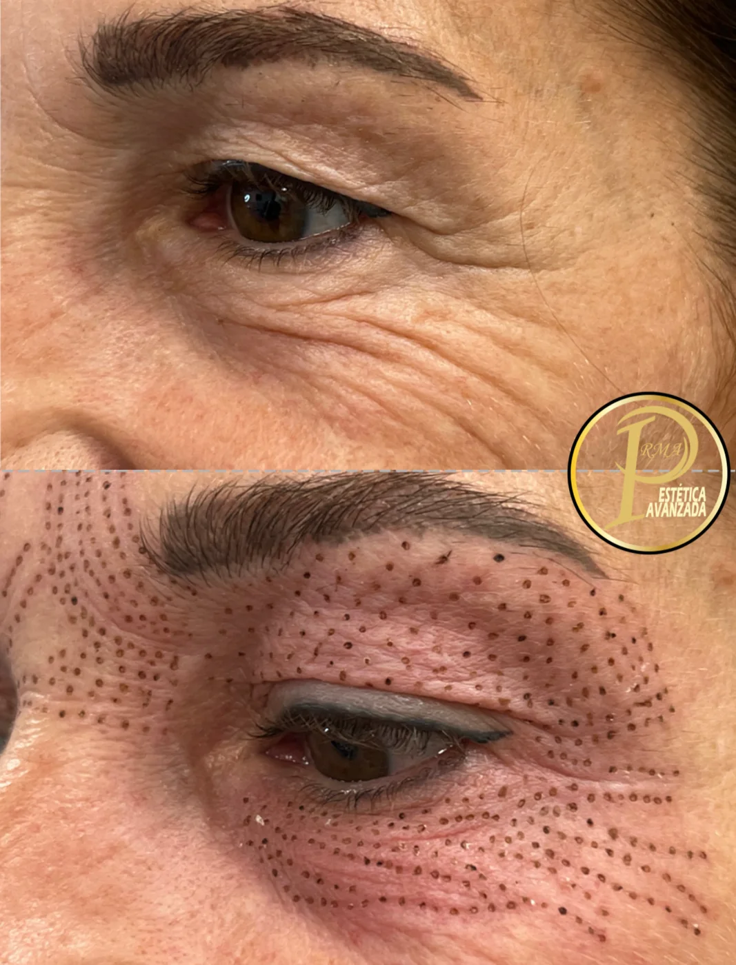 Contorno de ojo antes del tratamiento y con la retícula de plasma marcada