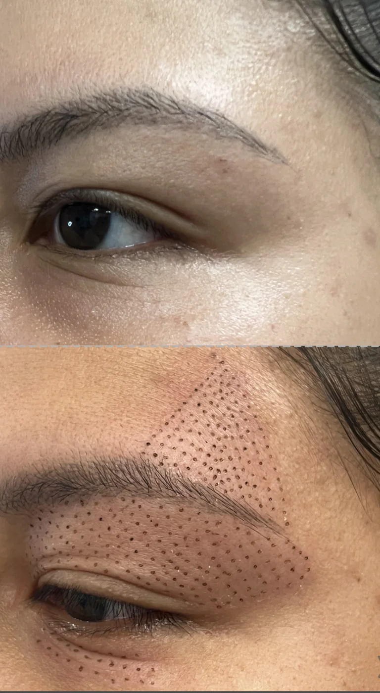 Contorno de ojo antes del tratamiento y con la retícula de plasma marcada