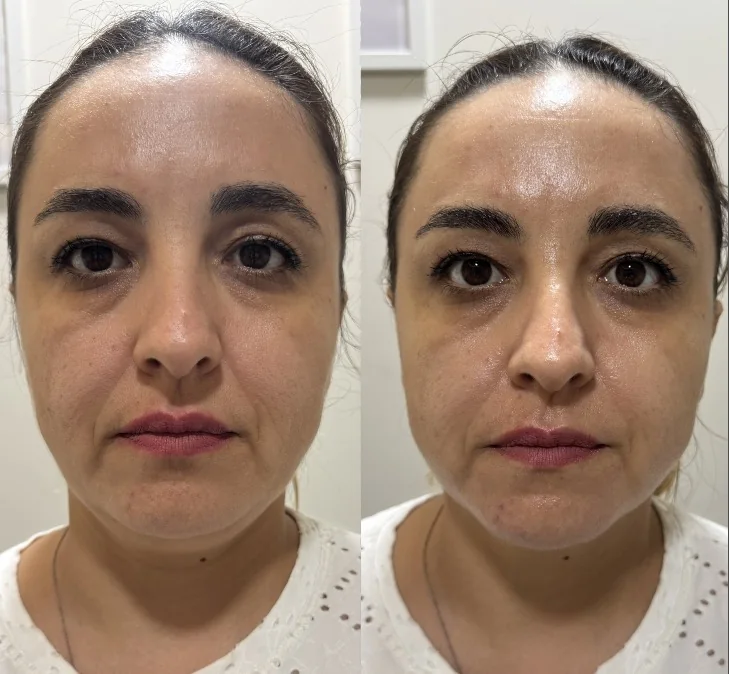 Comparativa frontal del rostro antes y después