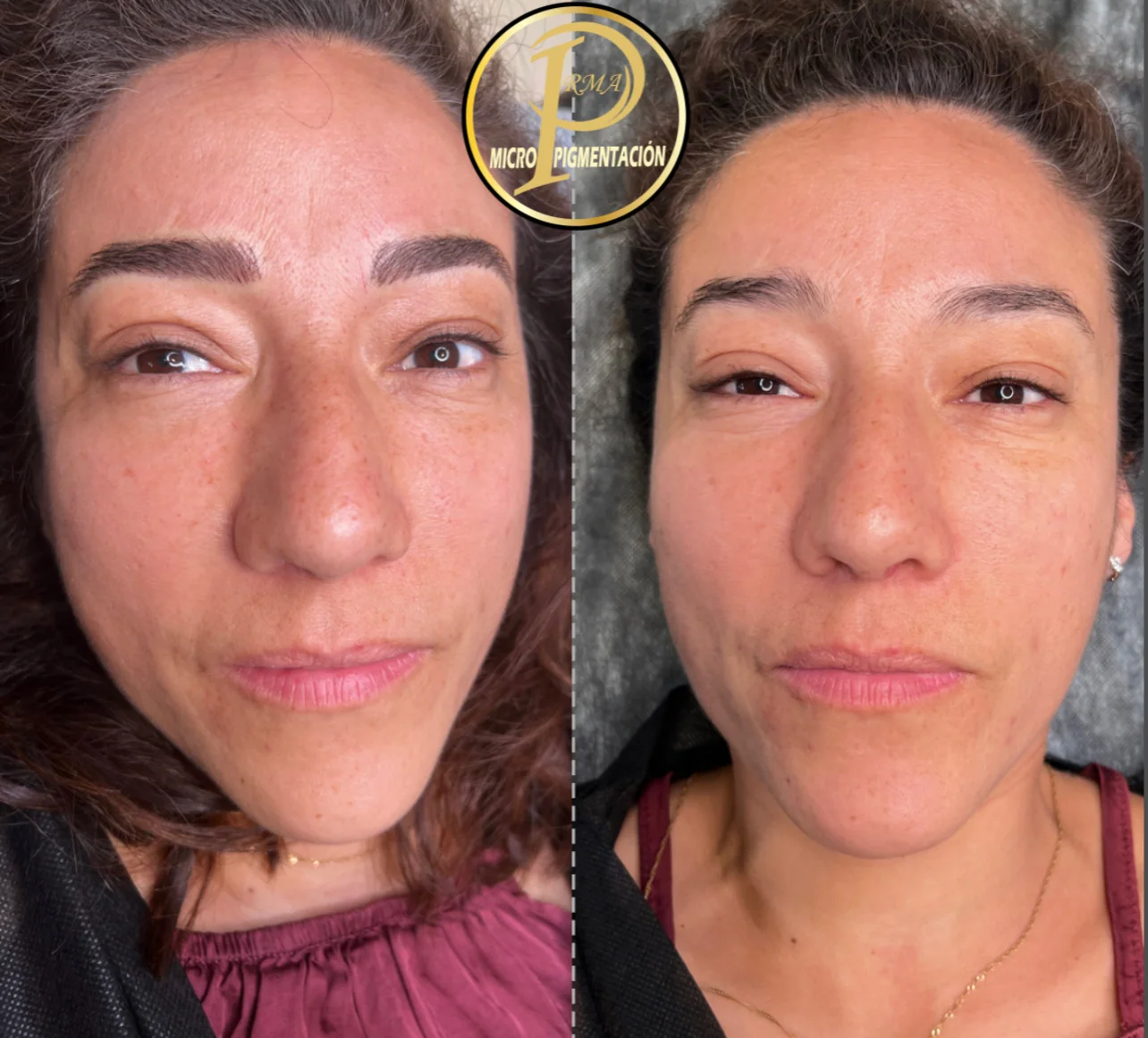 Rostro completo antes y después del tratamiento