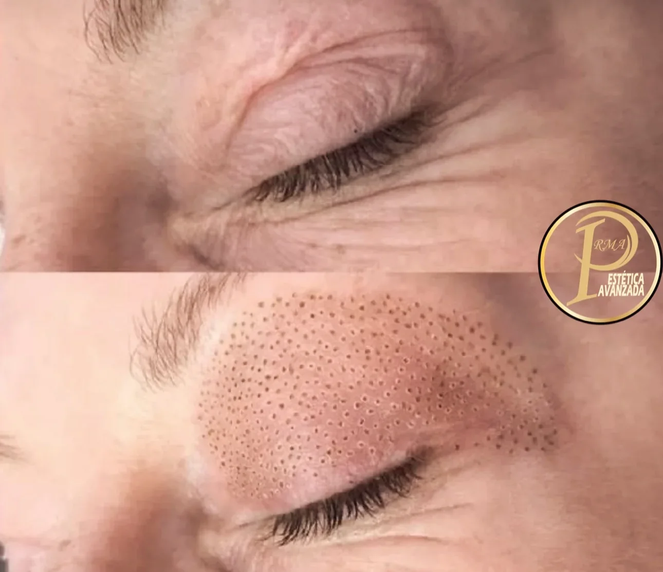 Zona de párpados y contorno de ojos tras el tratamiento con plasma
