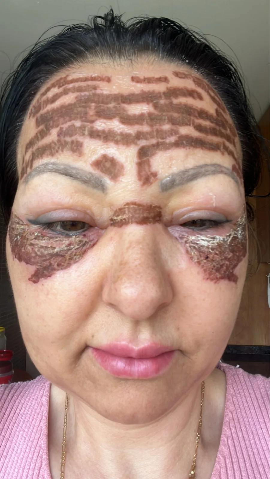 Rostro con la retícula de plasma marcada en frente y contorno de ojos