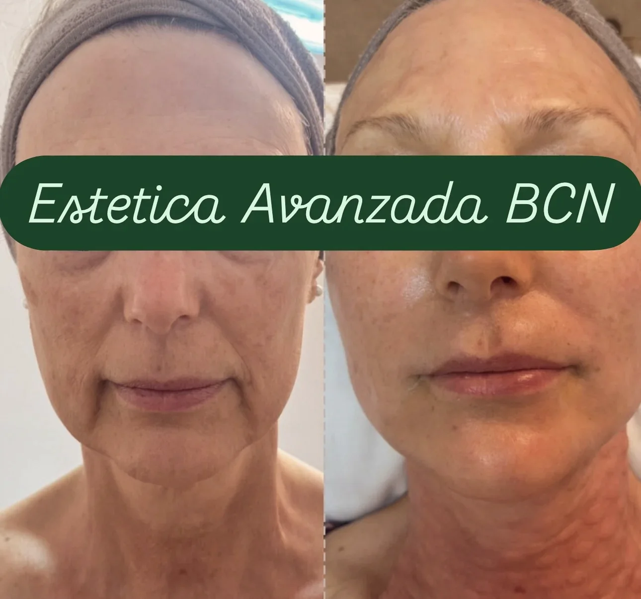 Rostro antes y después del tratamiento facial
